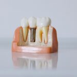 Step-by-Step Guide to Getting Dental Implants Hungary Helvetic Clinics