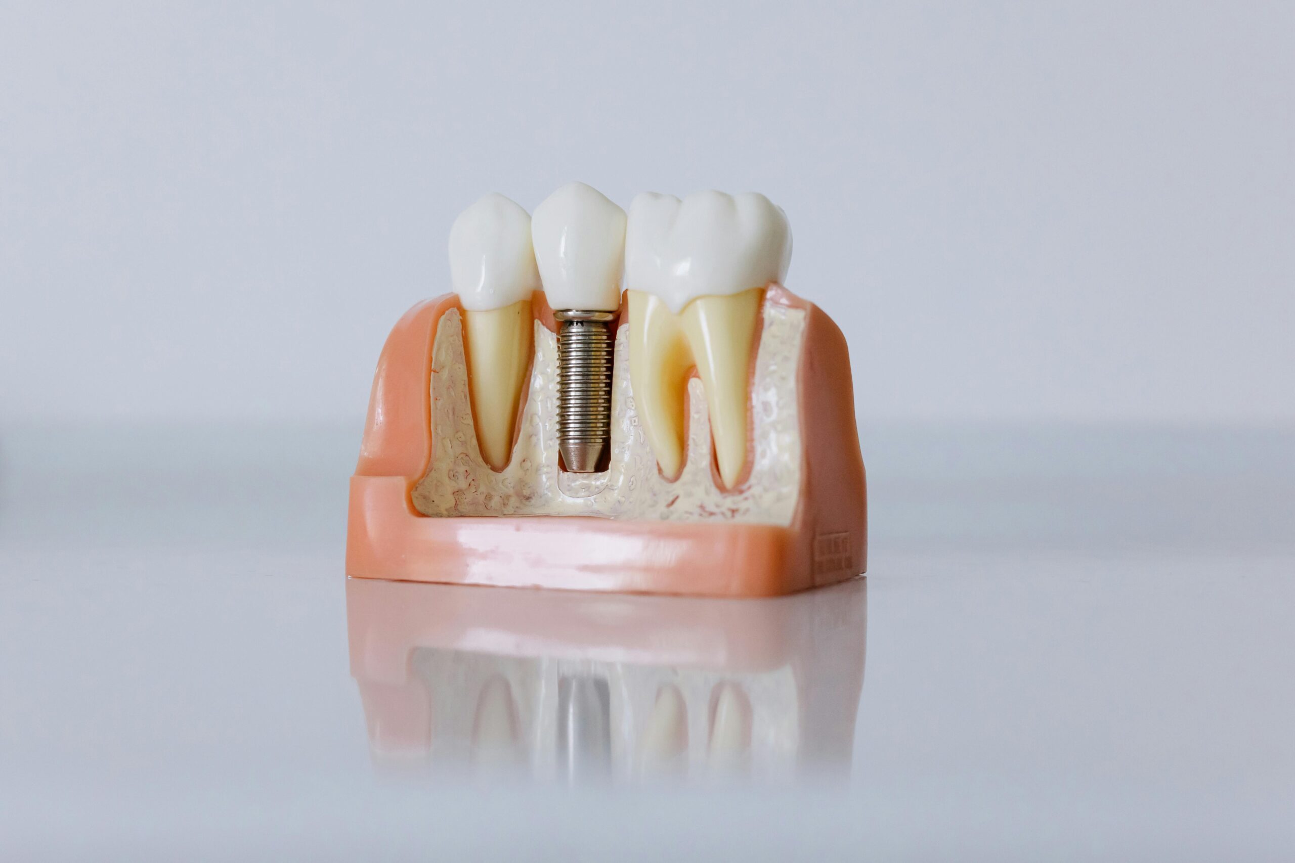 Step-by-Step Guide to Getting Dental Implants Hungary Helvetic Clinics